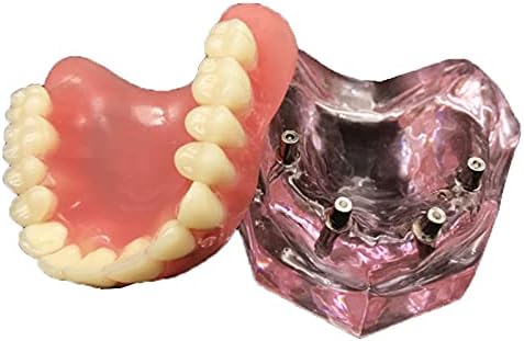 KH66ZKY транспарентен модел на имплантација на заби, преголема надградба на горните заби 4 импланти Демо стоматолошки модел